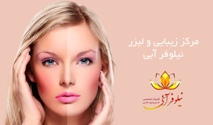 لیزر الکس کندلا در رودهن
